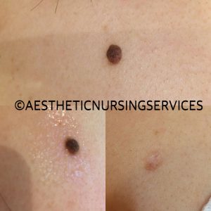 Advanced cosmetic procedures, mole treatment