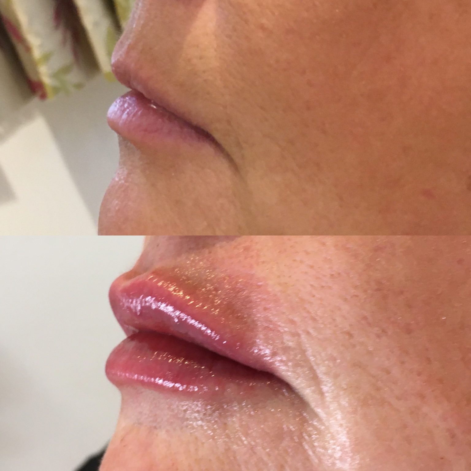 belotero lips before and after